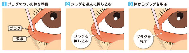 ドライアイの治療