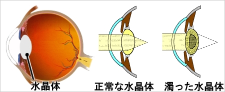 白内障