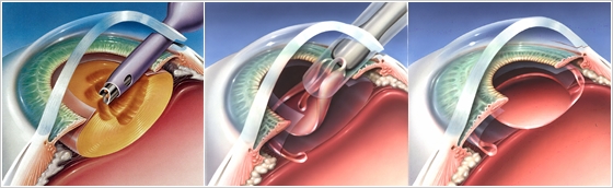 白内障手術の流れ