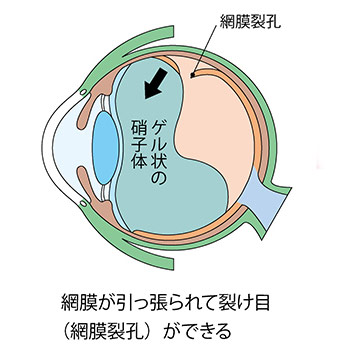 網膜剥離