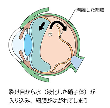 網膜剥離