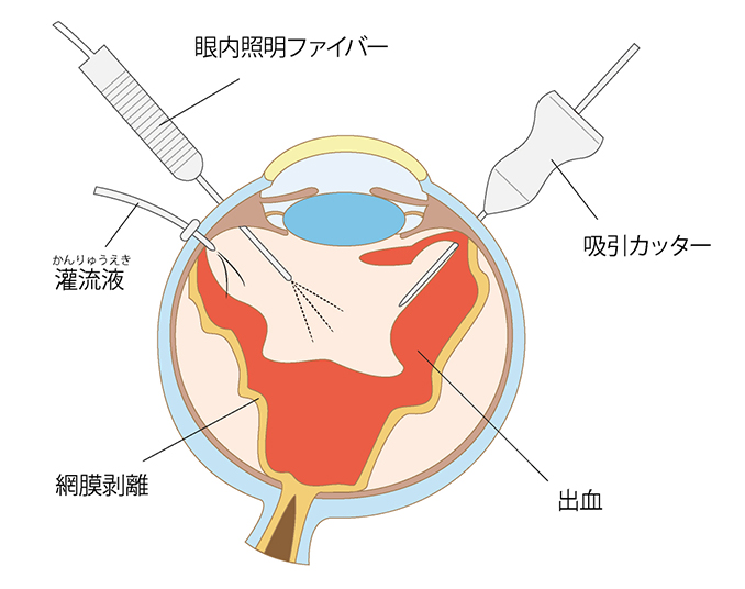 レーザー光凝固