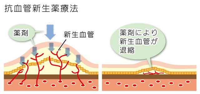 抗血管新生薬療法